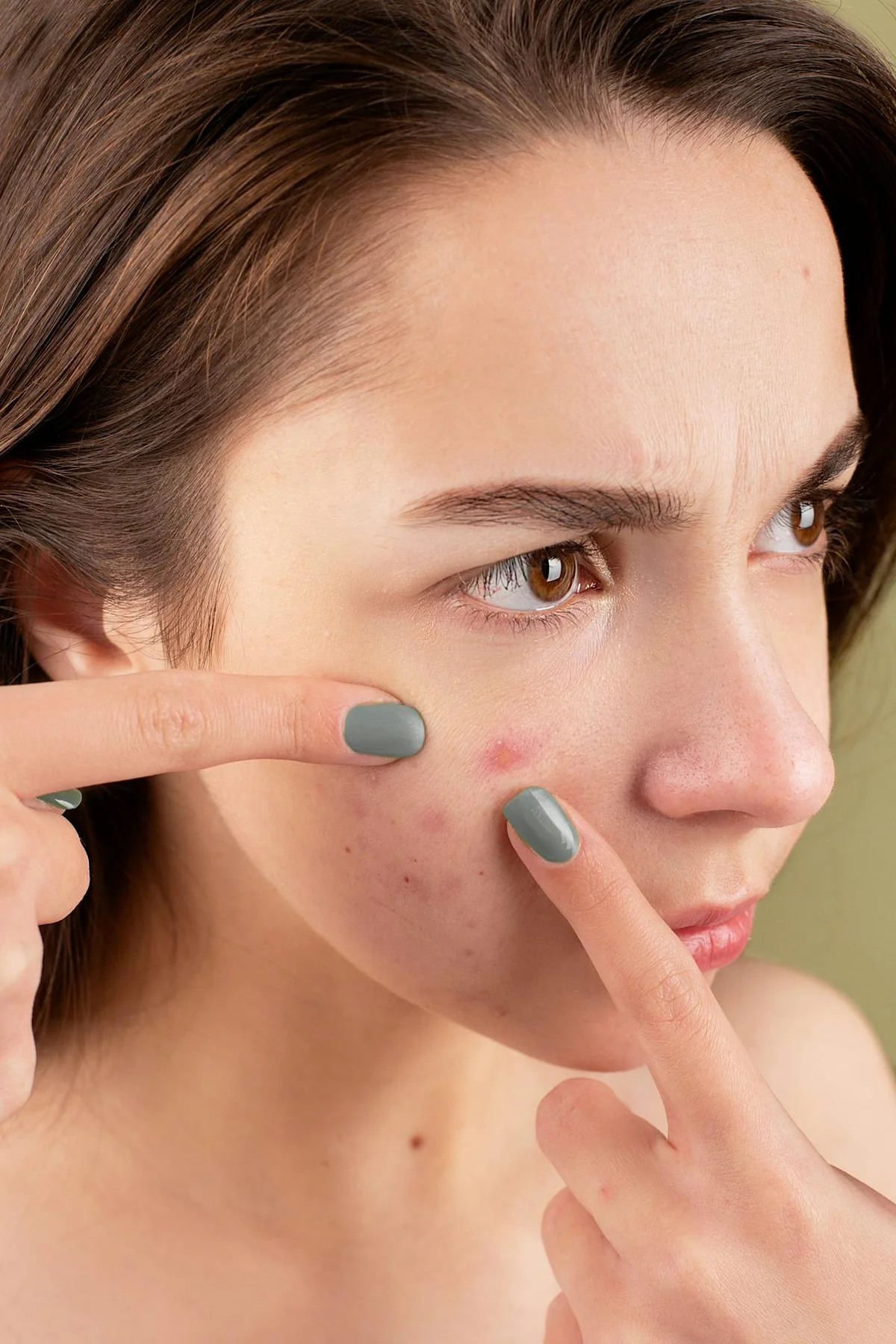Acne Awareness Month: Breaking the Stigma, Spreading the Facts